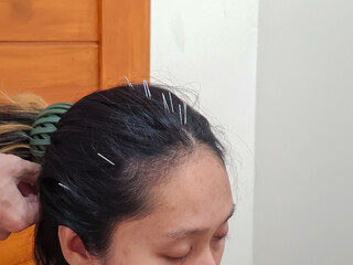 Front view, Acupuncture on the head to balance the body, reduce dizziness, headache, migraine....