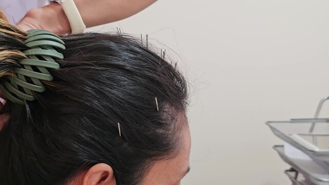 Side view, acupuncture on the head to balance the body and relieve dizziness