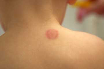 Mosquito bite on child back in a playful indoor setting during daytime