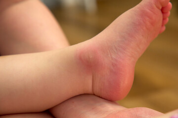 Holds a child foot that displays noticeable redness and swelling from a mosquito bite.