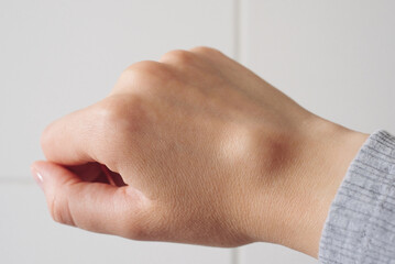 Female right back hand with ganglion cyst on the dorsum,  fluid-filled bump associated with a joint...