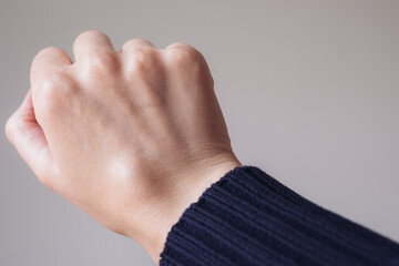 Female right back hand with ganglion cyst on the dorsum,  fluid-filled bump associated with a joint or tendon sheath, close-up view, selected focus.