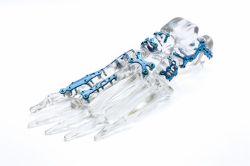 A surgical foot plate on a foot model on a white background.