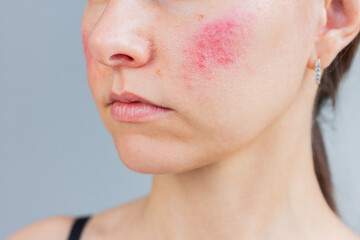 Young Caucasian woman suffering from rosacea on her face in the acute stage, she showing redness on...