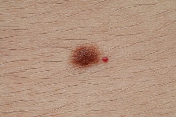 Man with moles on his body, closeup