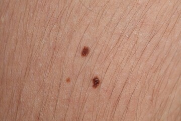 Woman with moles on her body, closeup