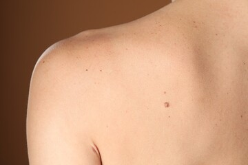 Naklejka premium Woman with moles on her body against brown background, closeup