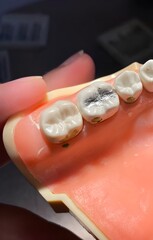 A class 1 amalgam filling on a molar 