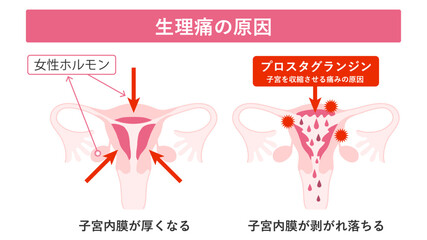 生理痛の原因