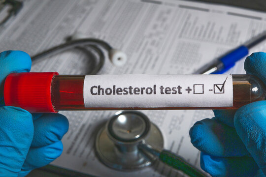 Doctor holding cholesterol blood test sample with positive result