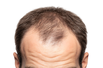 Close up of a man's receding hairline.