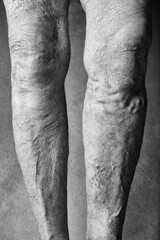 Legs of an elderly woman. Varicose veins on a female legs. The concept of accepting old age and beauty in old age. Toned image, black and white image.