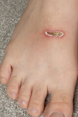 Abrasions on Top of Feet After Swimming with Fins