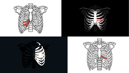  Set of rib cage icons with highlighted fractures for injury education