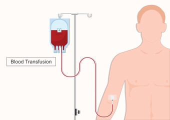 Blood transfusion is a medical procedure where blood.
