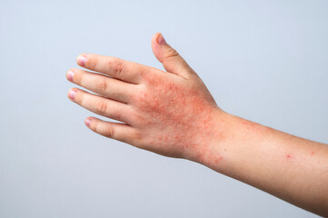 Red rashes from the Coxsackie virus on child hand on white background. Chicken pox allergy symptoms...