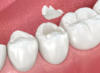 Inlay ceramic crown placement. Medically accurate 3D animation