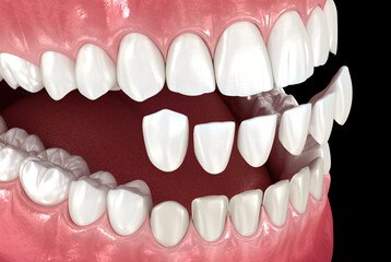 Dental veneer placement over frontal teeth. 3D illustration