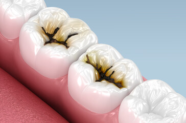 Molar teeth damaged by caries. Medically 3D illustration