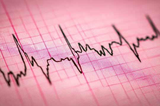 Medical heartbeat monitor displaying vital signs on an electrocardiogram sheet