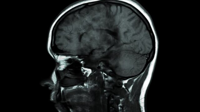 A detailed MRI scan of a human brain from a side view. The scan reveals the intricate structures of the brain, including the cerebral cortex, ventricles, and brainstem
