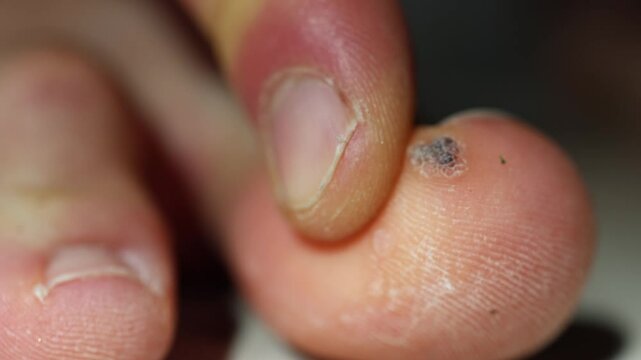 Extreme closeup of a human toe with a rough wart and cracked nail dry textured skin highlighted by harsh lighting evoking discomfort and clinical focus on dermatological imperfection