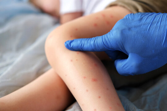 Doctor examining child with bodily red rash. Kid allergy closeup. Little baby scratches an eruption. Nurse applies special cream to atopic skin. Dermatitis, irritation, hive. Pruritus. Mosquito bites