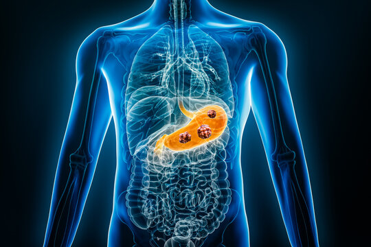 X-ray anterior or front view of human stomach with cancer cells 3D rendering illustration with male body contours. Anatomy, organ of digestive system, medical, biology, oncology, healthcare concepts.