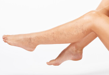 Beautiful slender woman sits on a couch in a spa salon. She shows varicose veins in the lower...