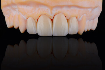 High-quality four dental crowns made of zirconium for fixation to the frontal teeth of upper jaw.