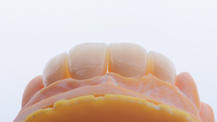 High-quality four dental crowns made of zirconium for fixation to the frontal teeth of upper jaw.