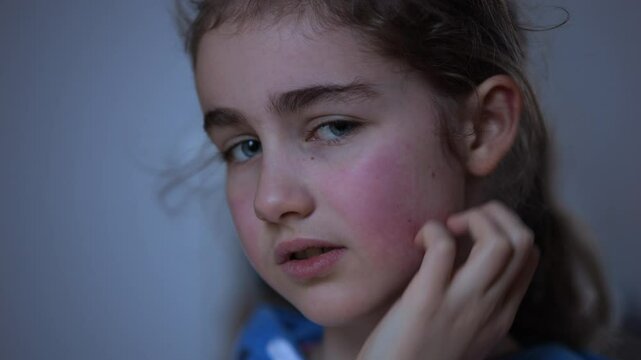 Girl Has Dry Red Skin and Scratching Her Face. Child Scratches Atopic Skin. Dermatitis, Diathesis, Allergy on Child Body and Face. Irritation and Pruritus. Kid Having Allergic Reaction on Skin to Food