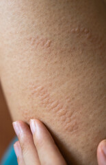 Fototapeta premium Close up image of skin texture suffering severe urticaria or hives or kaligata on leg. Allergy symptoms.