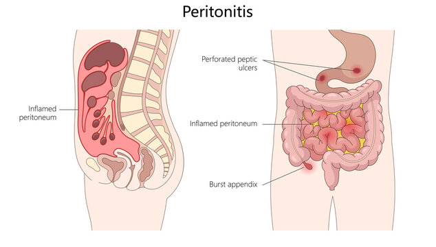 internal inflammation from peritonitis, highlighting burst appendix structure diagram hand drawn schematic raster illustration. Medical science educational illustration
