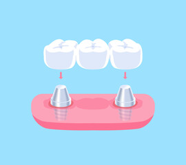 Implant supported bridges teeth illustration vector design. Dental care concept.