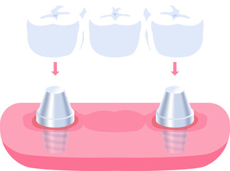 Implant supported bridges teeth illustration design. Dental care concept.