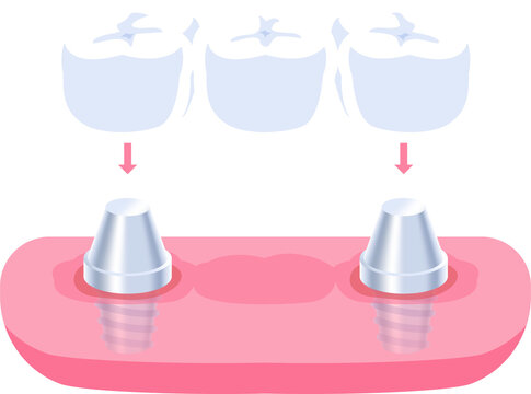 Implant supported bridges teeth illustration design. Dental care concept.