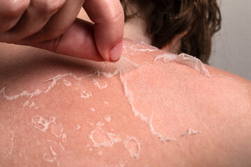 Peeling Skin on Shoulder After Sunburn Indicating Damage, Dryness, and Skin Recovery Process