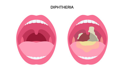 Diphtheria oral disease