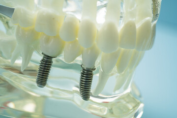Dental implant, artificial tooth roots into jaw, root canal of dental treatment, gum disease, teeth...