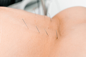 Acupuncture needles inserted into patient back during medical therapy. Traditional pain relief...