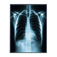 Detailed X-ray Image of Human Chest and Rib Cage Structure
