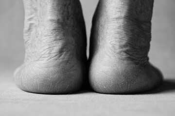 Cracked heels of an elderly man. Toned image, black and white