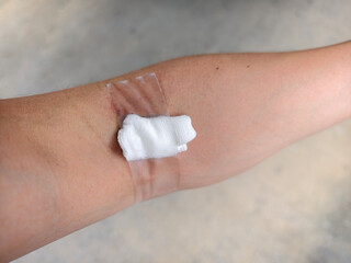 Arm with Cotton and Tape After Blood Donation. Close Up View