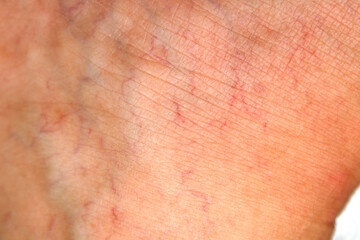 Close-Up of Human Skin With Red Veins and Texture Details