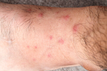 Close-Up View of Skin Irritation on Human Ankle with Red Bumps
