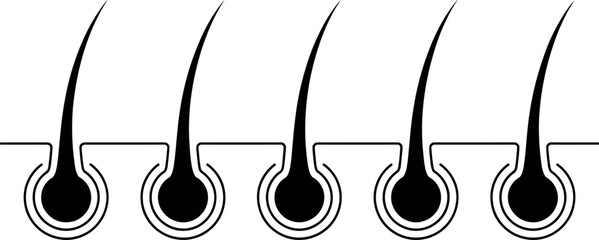 Hair follicle growth stages: five black vector illustrations.