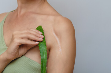 Aloe leaf indicate postoperative scar on shoulder woman. Scar healing, treatment of scars on skin.