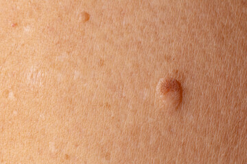 Close-up of a raised mole on caucasian skin