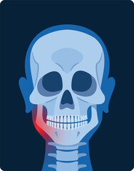 Jaw inflammation x-ray front view